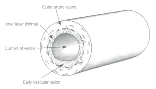 Vascular disease introduction graph 2